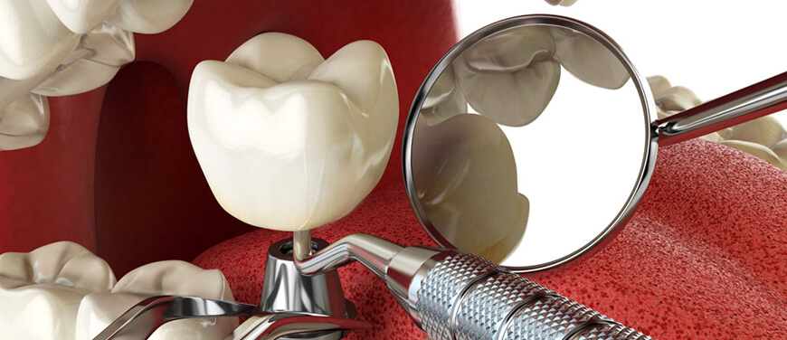 Dental İmplant